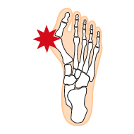 イラスト:インソールプロ メンズ 外反母趾対策