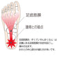 足底筋膜炎は足裏にある足底筋膜が炎症を起こし、痛みがでます。かかとの中心部分が痛む方が多いです