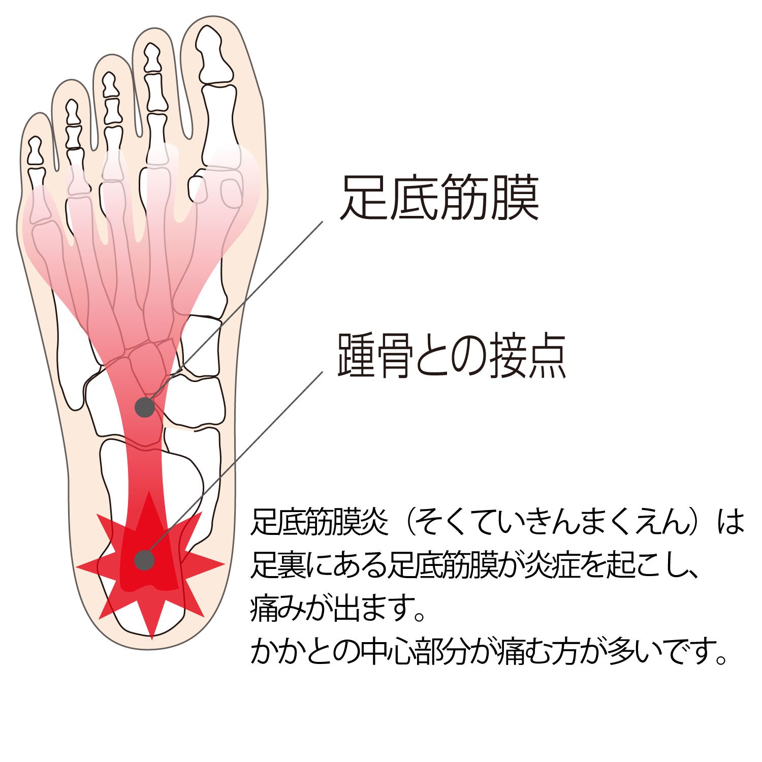 足底筋膜炎は足裏にある足底筋膜が炎症を起こし痛みが出ます。かかとの中心部分が痛む方が多いです