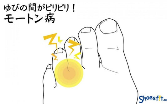 【足の症状シリーズ】ゆびの間がピリピリ！モートン病とインソールの話