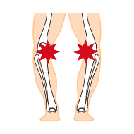イラスト：インソールプロ レディス 膝痛対策