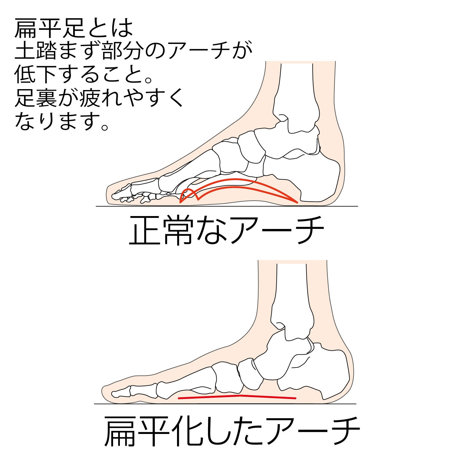 扁平足とは土踏まず部分のアーチが低下することです。足裏が疲れやすくなります