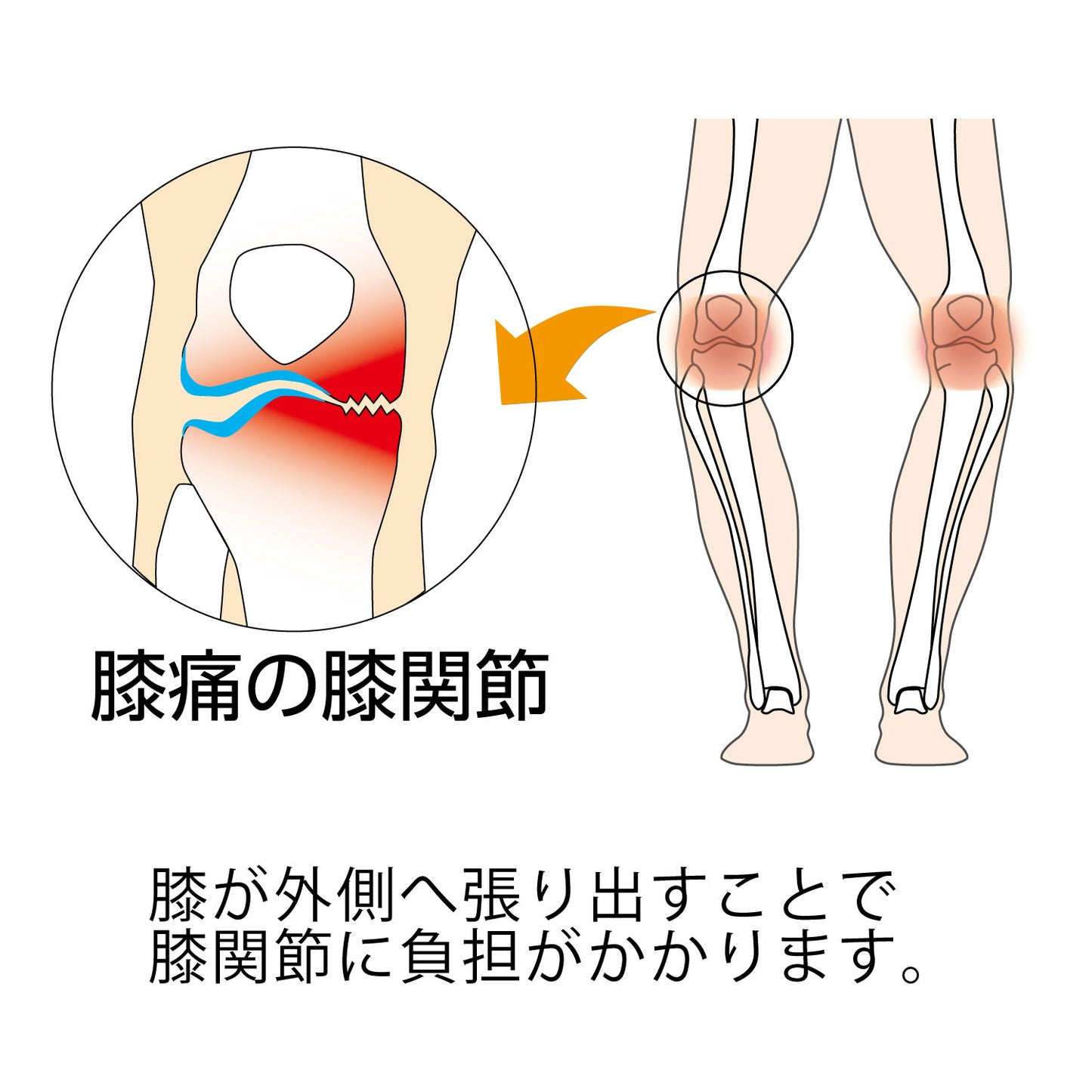 膝が外側に張り出すことで膝関節に負担がかかり痛みを生じます