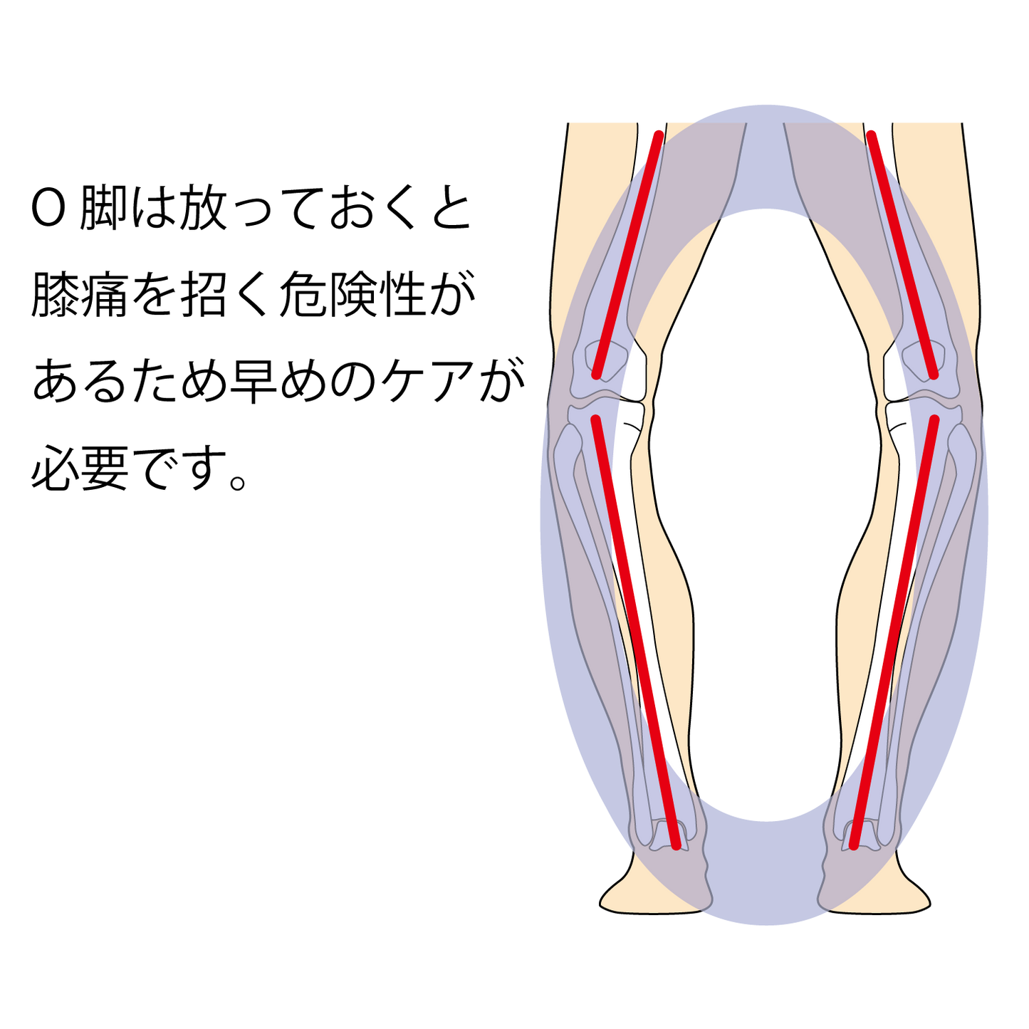 O脚は放っておくと膝痛を招く危険性があるため早めのケアが必要です