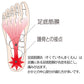 足底筋膜炎は足裏にある足底筋膜が炎症を起こし痛みが出ます。かかとの中心部分が痛む方が多いです